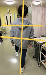 アイ フットケアインソール　Oさん　右片足立ち　インソール作製後