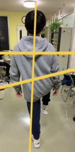 アイ フットケアインソール　Oさん　左片足立ち　インソール作製後